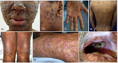 Emergomycosis, an Emerging Systemic Mycosis in Immunocompromised Patients: Current Trends and Future Prospects